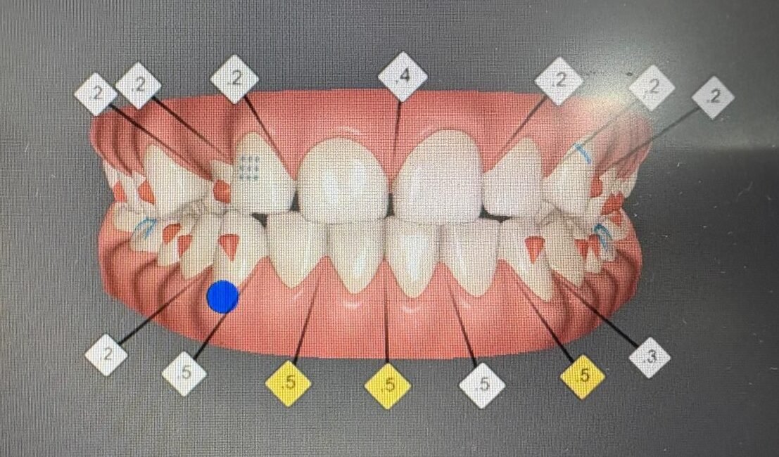 Tratamiento Invisalign Bogotá