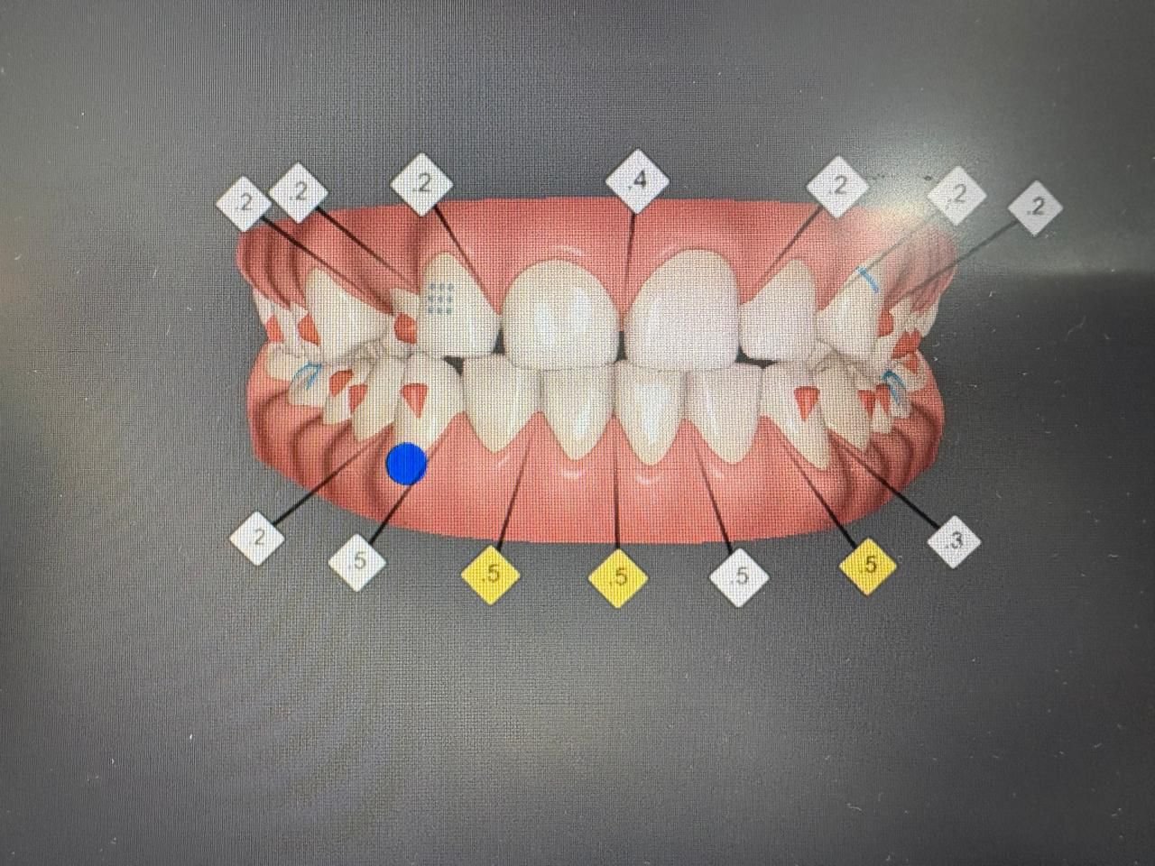 Tratamiento Invisalign Bogotá