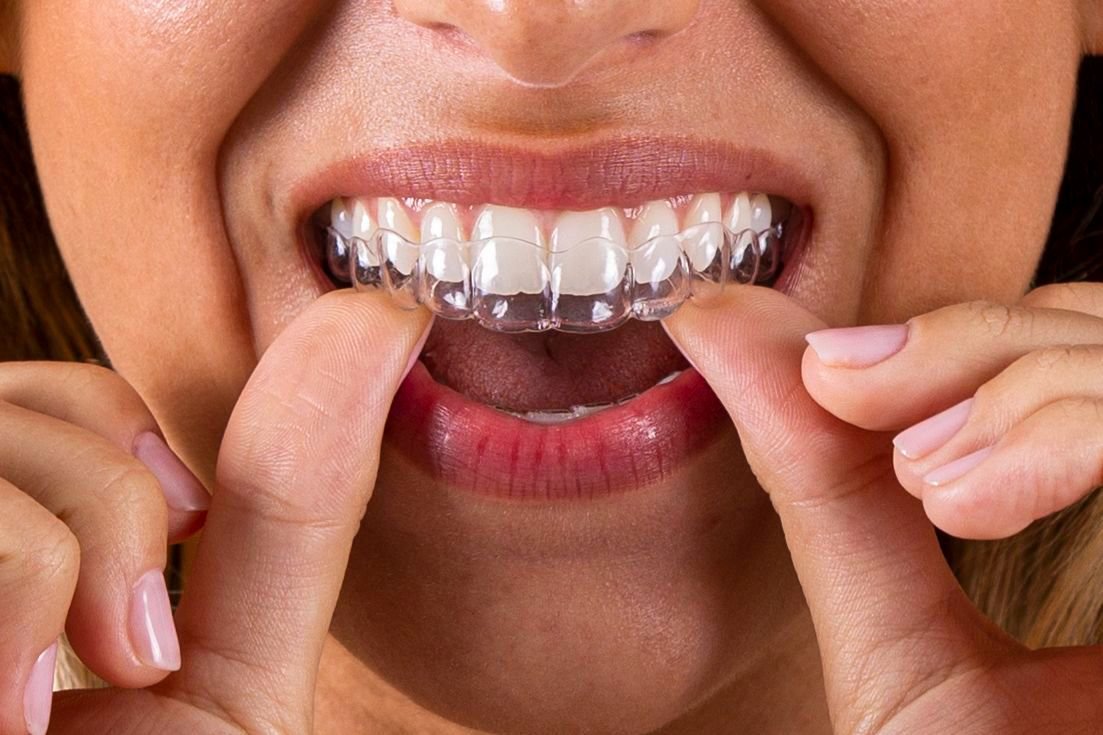 Invisalign Colombia